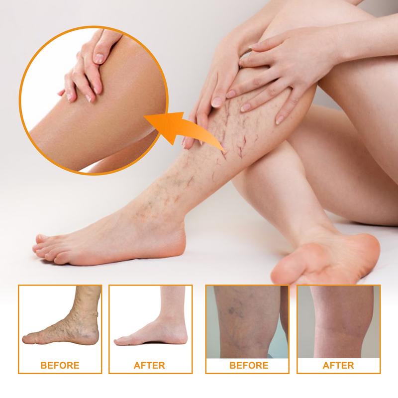 EELHOE Vitamin K Cream for Sore and Swollen Legs - Earthworm Leg Vein Massage Cream - Facial, Comfort Aloe Body Care