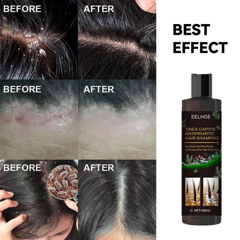 Scalp Ringworm Anti-itch Shampoo Anti-drop Refreshing Oil Control Hair Care Anti-dandruff Anti-itch Shampoo Deep into The Hair Root Protection Hair Follicle Anti-dandruff Anti-mite Anti-itch Prevent Dandruff Recurrence Conditioner Hair care