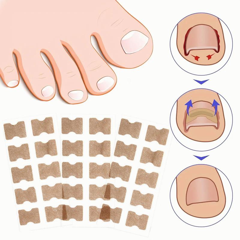 Ingrown Toenail Correction Patch, 30pcs set Breathable Toe Nail Correction Strip, Professional Pedicure Tool for Home & Beauty Salon Use